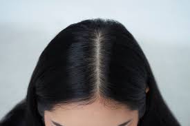 Dandruff free scalp