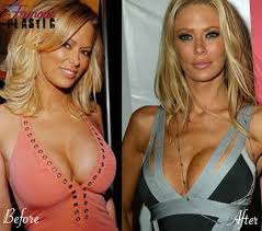 Porn star boob jobs before after iii jpg x Before plastic surgery