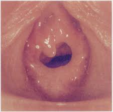 hymen child|Documenting Child Sexual Abuse