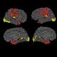 Brains Of Schizophrenia Patients Attempt To Self-Repair, MRI Scans Reveal 