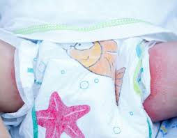 diaper rash naked |Common causes of diaper rash—plus four ways to treat it - Today's Parent