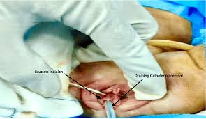 hymen child|Normal Examination Findings and Variants | SpringerLink