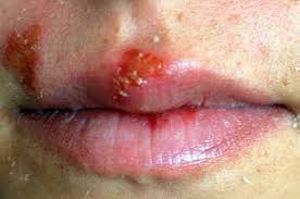 HERPES