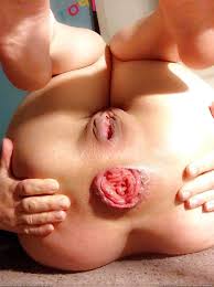 Prolapse anal gape jpg x Prolapse anal gape