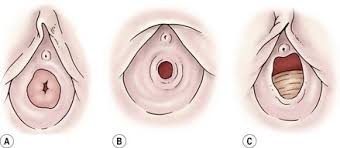 hymen child|Hymen - an overview | ScienceDirect Topics