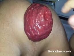 Nasty anal highlights jpg x Rectal prolapse