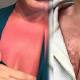 Melbourne woman blames severe sunburn on faulty Banana Boat sunscreen 