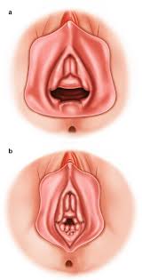 Hymen vagina|Imperforate hymen: Causes, Risk Factors, Symptoms, Treatment