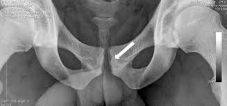 pubis spread|Pubic Symphysis (Human Anatomy): Picture , Functions ...