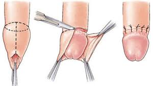 Отрезание пениса|Обрезание крайней плоти в Мытищах - УроКлиника.
