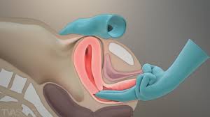 child examination vagina|Pelvic examination - Wikipedia