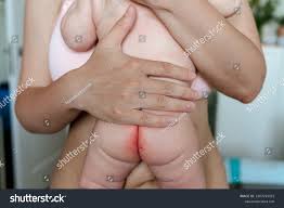 diaper rash naked |Diaper rashes can indicate systemic conditions other than diaper dermatitis  | BMC Dermatology | Full Text