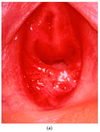 child hymen |Imperforate hymen presenting as vaginal cyst in a 16-month-old child –  considerations for an early diagnosis - Nedeljka Glavan, Herman Haller,  Alemka Brnčić–Fischer, Lana Glavan-Gačanin, Damir Miletić, Nives Jonjić,  2016
