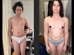 mtf transition nude|MTF Vaginoplasty Results Gallery - Keelee MacPhee, M.D.