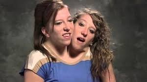 Freak house siamese twins new fetish movies jpg x Conjoined twins