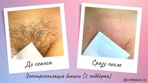 Первые волосы на письке |Электроэпиляция глубокого бикини в Москве - центр Вселенная красоты