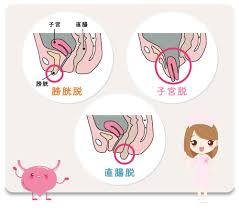 子宮脱|骨盤臓器脱(子宮脱) – 江戸川区の産婦人科・小児科 – まつしま病院｜WEB予約が可能