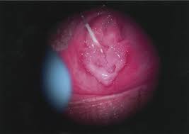 hymen child|Mimics” of Injuries from Child Abuse: Case Series and Review of the  Literature