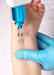 remove tattoo stock|Tattoo Removal Male Royalty-Free Images, Stock Photos & Pictures |  Shutterstock