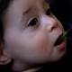 Preventing Food Allergies May Start in Infancy 