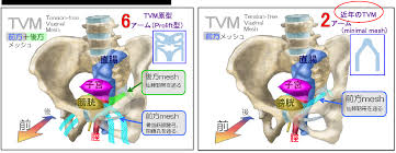 子宮脱|58 : 膣脱・子宮脱整復手術 / 【出産後の膣脱・子宮脱】 | 林動物病院