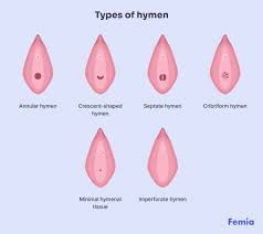 hymen child|Assessments of Girls' Genital Findings and the Likelihood of Sexual Abuse