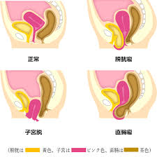 子宮脱|骨盤臓器脱の治療について | 医療法人社団實理会 東京国際大堀病院