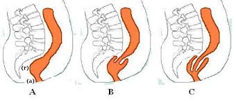 Anal prolapse sex jpg x Anal prolapse sex