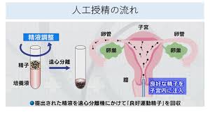 子宮口精子注射画像|不妊治療検査 ｜ みたき総合病院 産婦人科〈三重県四日市市〉