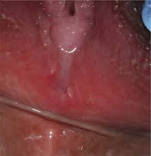 child hymen |Hymen Breakage Signs: Learning The Anatomy And Debunking Myths - Femia