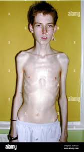 anorexic teens|Heartbreaking photos show how a group of girls is dealing with anorexia -  The Washington Post