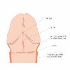Отрезание пениса|Обрезание крайней плоти, циркумцизия в Николаеве | Смерницкий Владимир