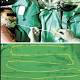 Doctors remove 6-foot tapeworm through man's mouth 