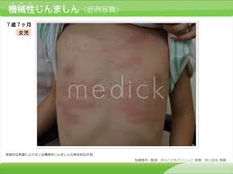 女児症例|7歳女児の内踝部に生じたsuperficial spreading melanoma in situの1例 (臨床皮膚科 55巻13号) | 医書.jp