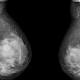 Double mastecomies for breast cancer tripled in last decade 