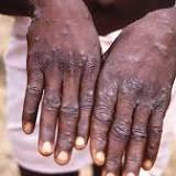 Sudan detects first case of monkeypox in Darfur, 38 more suspected