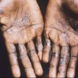 Oregon reports first probable case of monkeypox in the state