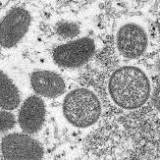 Douglas County reports third suspected case of monkeypox
