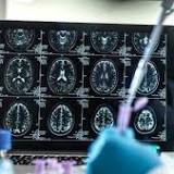 Alzheimer: Kombination zweier Viren kann Krankheit auslösen
