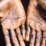 Warning in Vic for rare monkeypox disease