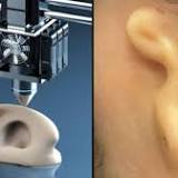 Doctors Transplant Ear of Human Cells, Made by 3-D Printer