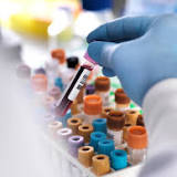 'Game-changer' blood test is even better at finding early breast cancers than a mammogram - especially among young ...