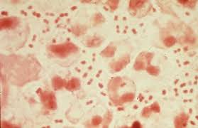 Gonorrea: Scoperto nuovo ceppo H041, resiste ai farmaci