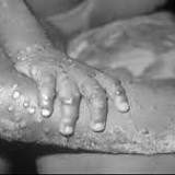What is monkeypox - symptoms of virus spread by wild animals after UK case found