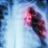 Protein contributes to drug tolerance in tuberculosis