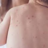 Anti-measles drive to cover 7m children: MoPH
