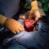 NYU Langone researchers transplant pig hearts into 2 brain dead patients