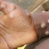 Australian cases of the Monkeypox virus rise to six