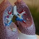 Early impact of SARS-CoV-2 on human lungs