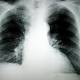 New lung cancer treatment preserves quality of life for mid-term patients, research finds 